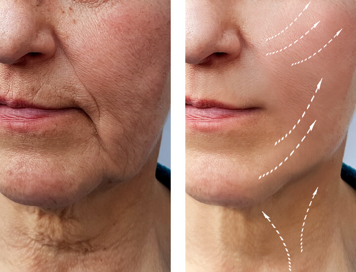 old woman wrinkles before and after procedures, facial