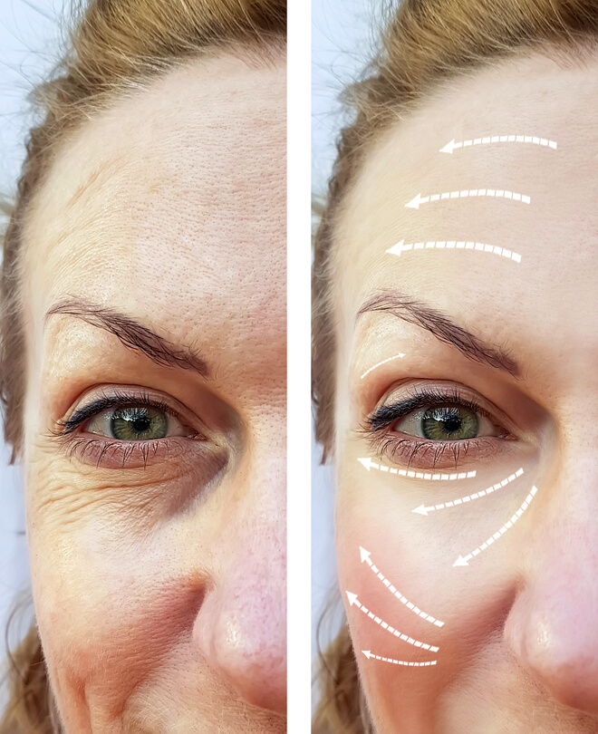 woman facial wrinkles before and after procedures